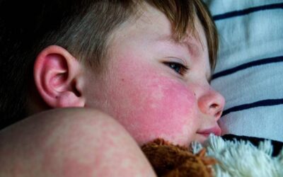 Co na wysypkę przy szkarlatynie stosować w domowych warunkach?