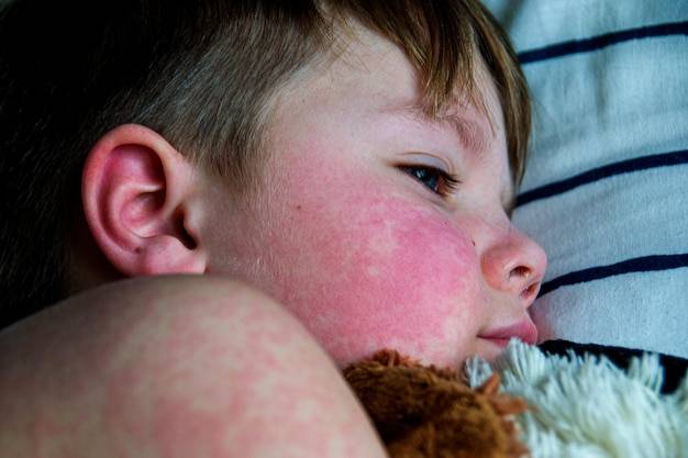 Co na wysypkę przy szkarlatynie stosować w domowych warunkach?