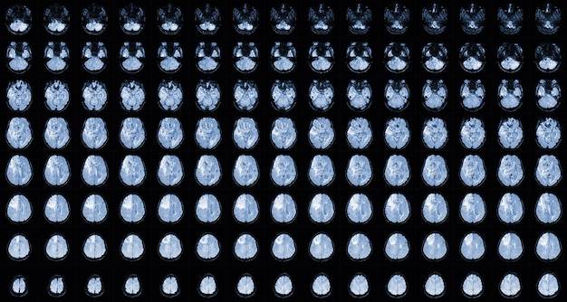 Tomografia z kontrastem jak wygląda takie badanie?