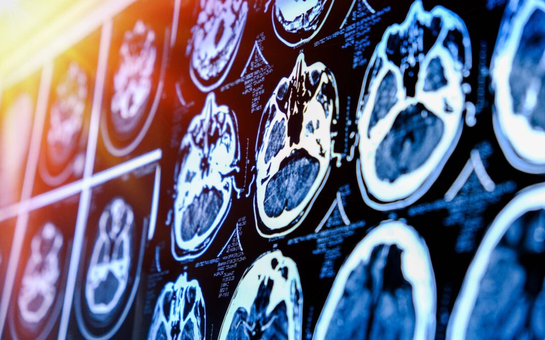 Co jest lepsze tomografia czy rezonans głowy w diagnostyce schorzeń?