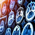 Co jest lepsze tomografia czy rezonans głowy w diagnostyce schorzeń?